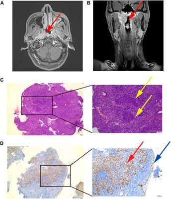 Effect of anlotinib combined with ticeorgio for recurrent nasopharyngeal carcinoma: a case report